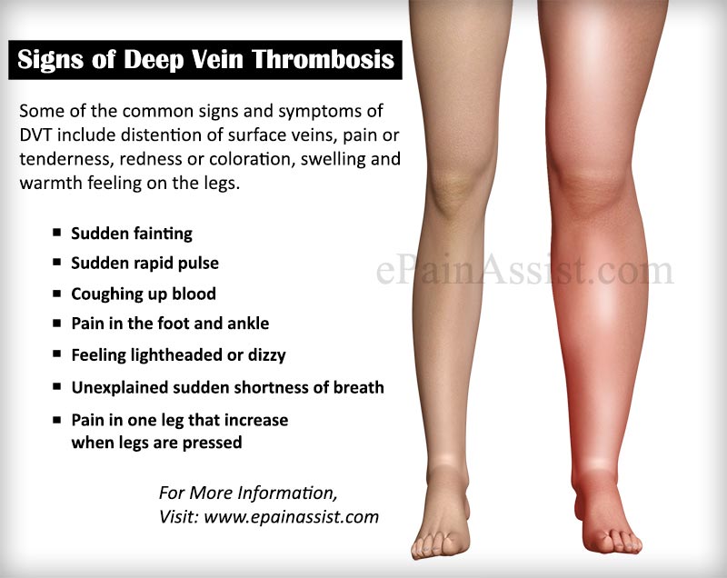 Signs of deep vein thrombosis preview